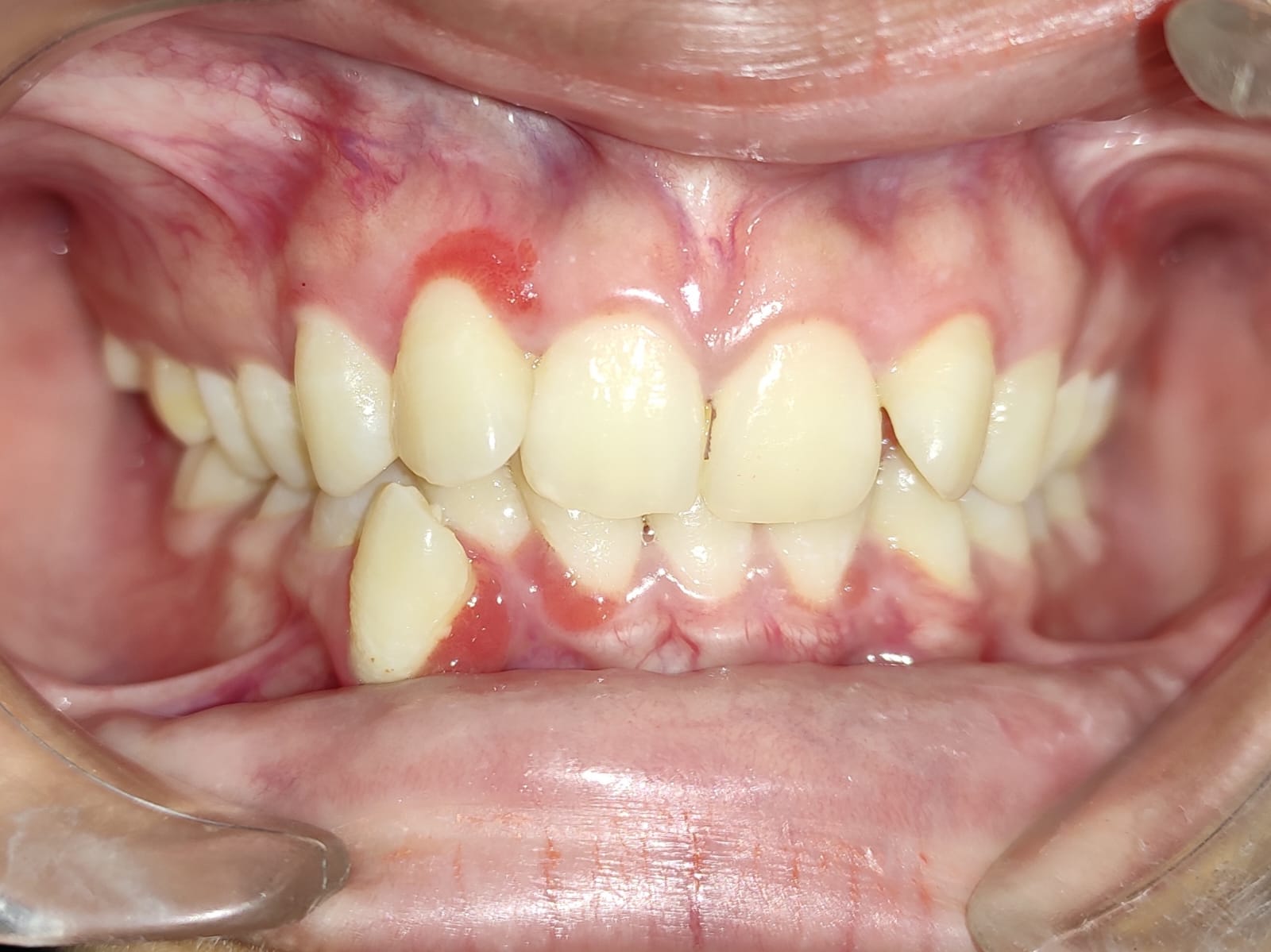 Severely crowded teeth with a blocked-out lower tooth before treatment
