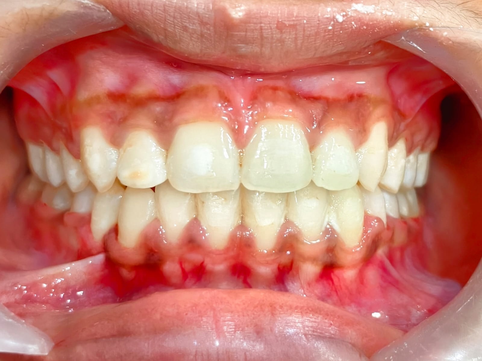 Even smile with spaces closed and teeth aligned after treatment