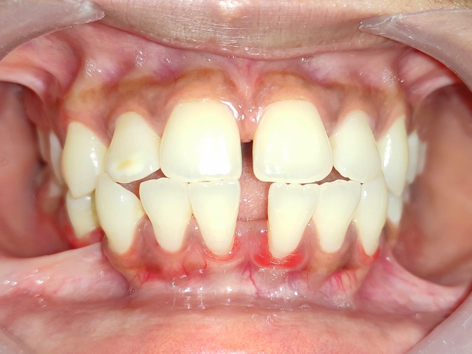 Spaced teeth with a gap between the upper front teeth before treatment